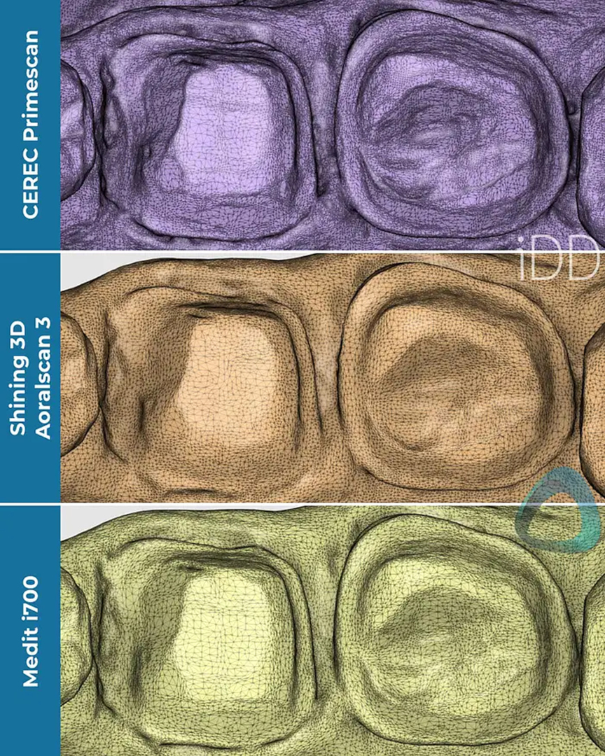 Fig. 10: Tessellated mesh with all the vertices of the scans compared. The CEREC Primescan and Medit i700 scans show detail in greater complexity, contributing to a better-rendered result in the colour scan.